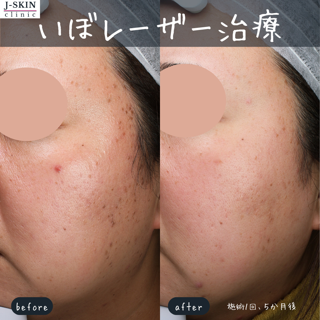 顔のザラザラ・ブツブツはレーザー治療可能なものもあります - JSKIN